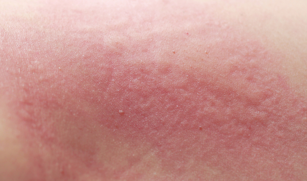 What Causes the Lupus Butterfly Rash? - Redorbit