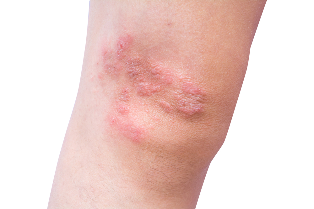 what-causes-dermatitis-herpetiformis-redorbit