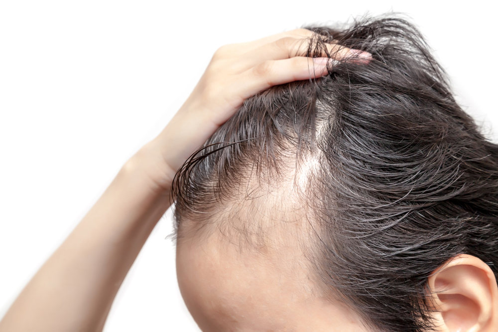 Can Hypothyroidism Cause Thinning Hair