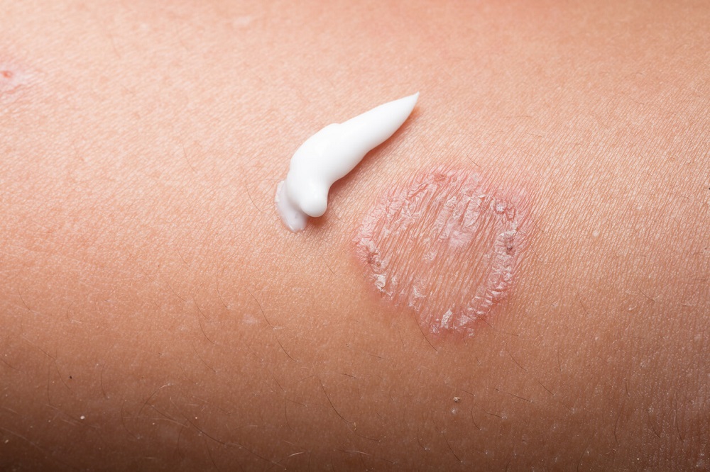 how-to-treat-ringworm-redorbit